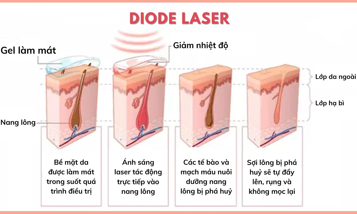 Công nghệ triệt lông diode